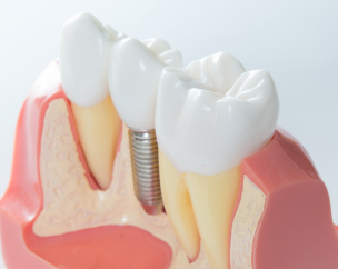 Implantes Dentales