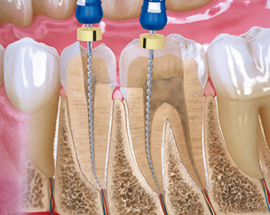 Endodoncia